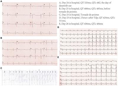 A case report of sudden cardiac arrest and torsade de pointes induced by the second-generation tyrosine kinase inhibitor dasatinib combined with fluconazole